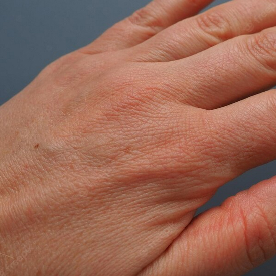 Dermatitis de Contacto
