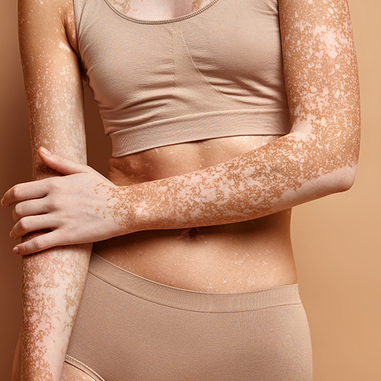 Vitiligo