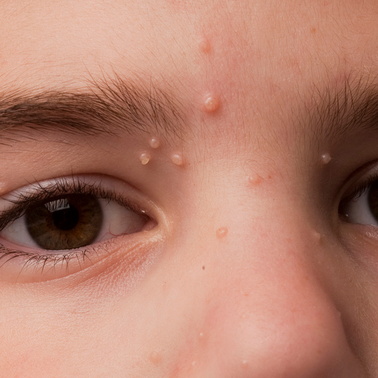 Moluscos Contagiosos